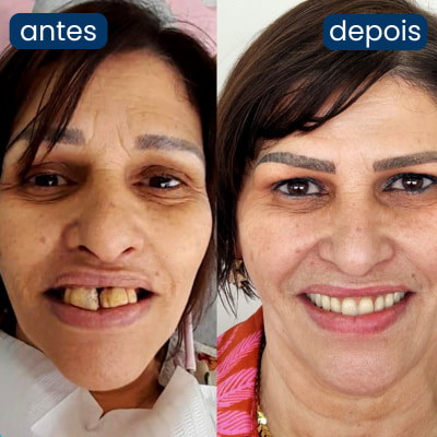 implante dentário personalidente 2