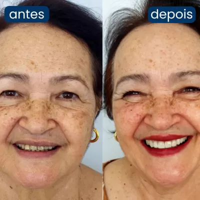 implante dentário personalidente 3