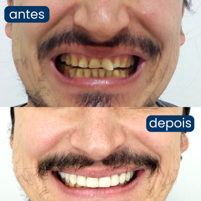 implante dentário personalidente 4